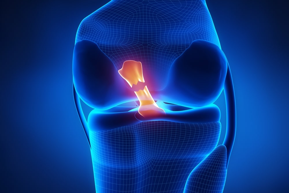 Anterior Cruciate Ligament ACL